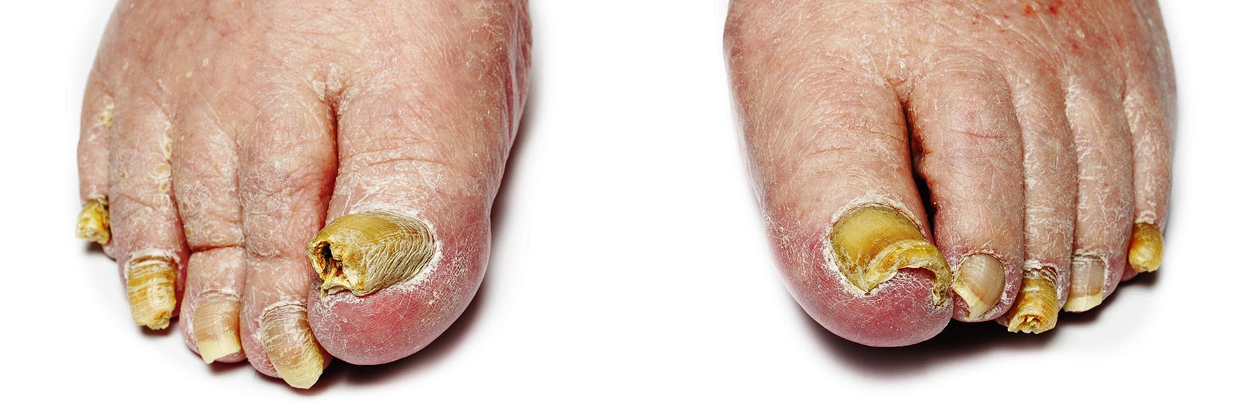 تشخیص بیماریهای ناخن همراه با عکس تشخیص بیماریهای ناخن همراه با عکس