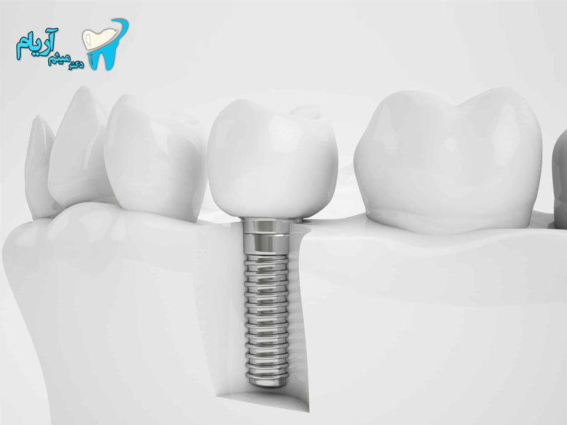 بهترین متخصص ایمپلنت تهران را بشناسید بهترین متخصص ایمپلنت تهران را بشناسید