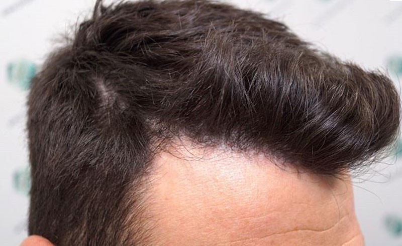 با مزایا و معایب کاشت مو بیشتر آشنا شویم با مزایا و معایب کاشت مو بیشتر آشنا شویم