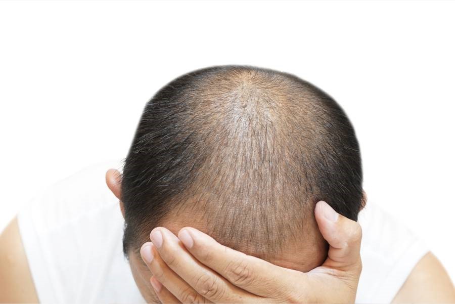 بهترین مرکز انجام کاشت مو و کاشت ابرو در تهران کجاست؟ بهترین مرکز انجام کاشت مو و کاشت ابرو در تهران کجاست؟