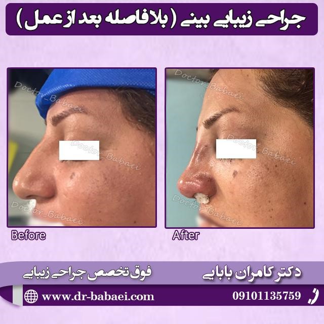 جراحی بینی توسط کامران بابایی فوق تخصص جراحی پلاستیک در اصفهان جراحی بینی توسط کامران بابایی فوق تخصص جراحی پلاستیک در اصفهان