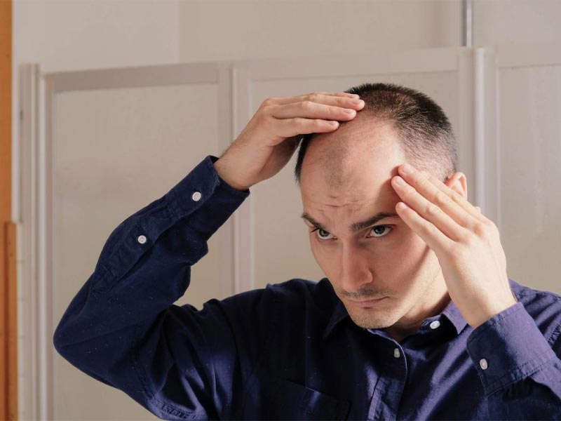 سن مناسب برای کاشت موی طبیعی