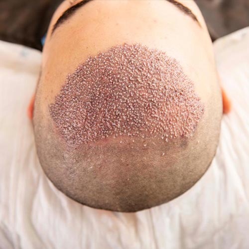 سن مناسب برای کاشت موی طبیعی