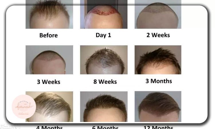 با به روزترین روشهای کاشت مو در ایران آشنا شوید کاشت مو