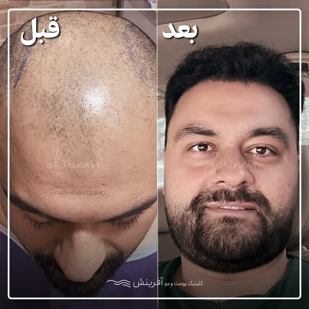 با به روزترین روشهای کاشت مو در ایران آشنا شوید پیشرفتهترین روشهای کاشت مو